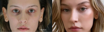 Brow Lift before and after photo