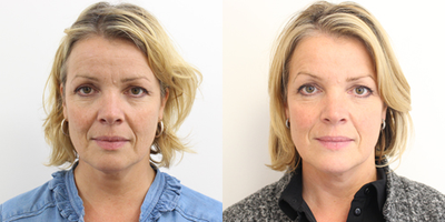 Dermal Fillers before and after photo