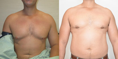 Gynecomastia Surgery before and after photo