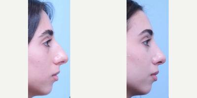 Rhinoplasty before and after photo