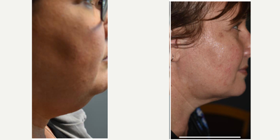 Chin Liposuction before and after photo