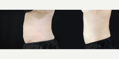 CoolSculpting before and after photo
