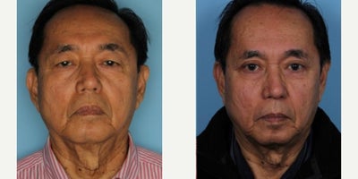 Eyelid Surgery before and after photo