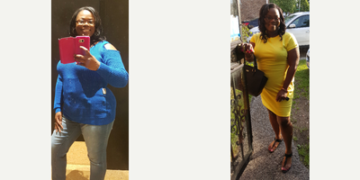 Orbera Gastric Balloon before and after photo