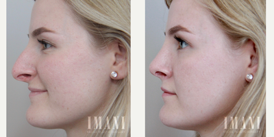 Rhinoplasty before and after photo