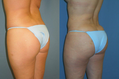 Butt Lift before and after photo