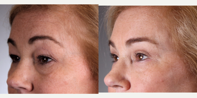 Facelift before and after photo