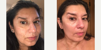 IPL before and after photo