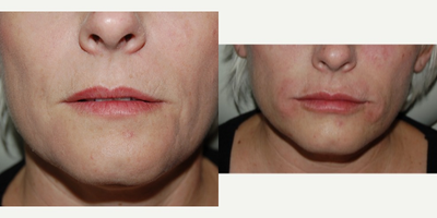 Lip Fillers before and after photo