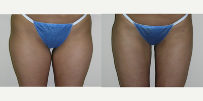 Liposuction before and after photo