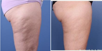 Morpheus8 before and after photo