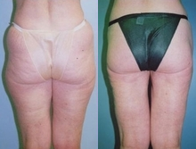 Butt Lift before and after photo