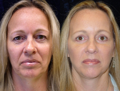 Eyelid Surgery before and after photo
