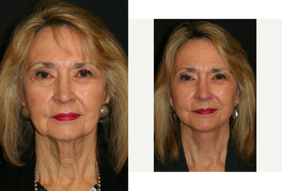 Facelift before and after photo