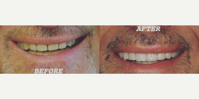 Teeth Whitening before and after photo