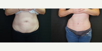 Tummy Tuck before and after photo