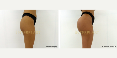 Butt Augmentation before and after photo