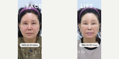 Chin Liposuction before and after photo
