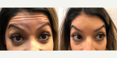 Dysport before and after photo