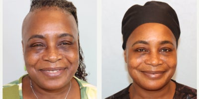 Eyelid Surgery before and after photo