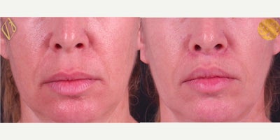 Lip Lift before and after photo