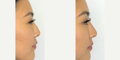 Bellafill before and after photo