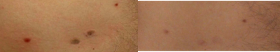 Laser Resurfacing before and after photo