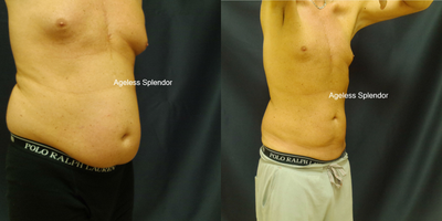 SculpSure before and after photo