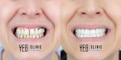 Smile Makeover before and after photo