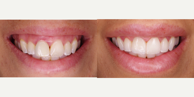 Dental Crown before and after photo