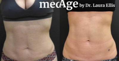 Emsculpt before and after photo