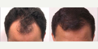 Hair Transplant before and after photo