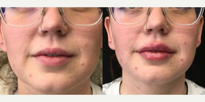 Lip Fillers before and after photo