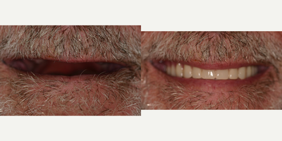 Smile Makeover before and after photo