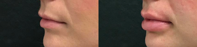 Volbella before and after photo