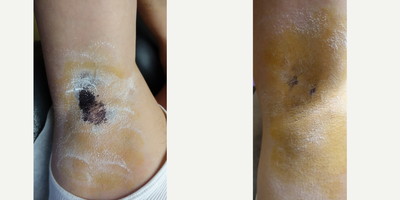 Botox before and after photo