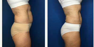 CoolSculpting before and after photo