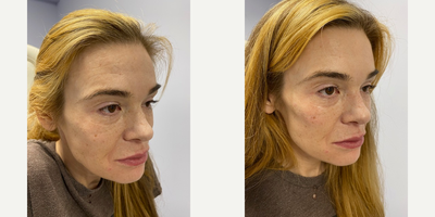 Liquid Facelift before and after photo