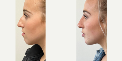 Nonsurgical Nose Job before and after photo