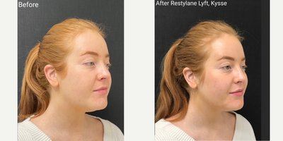 Restylane Lyft before and after photo