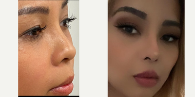 Rhinoplasty before and after photo