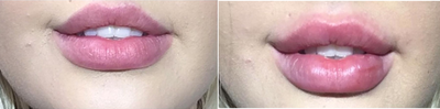 Vollure before and after photo