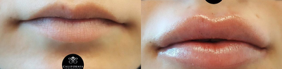 Dermal Fillers before and after photo