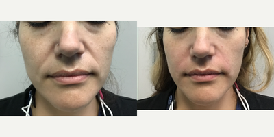 Juvederm before and after photo