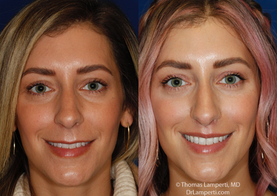 Lip Lift before and after photo