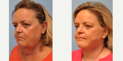 Neck Lift before and after photo