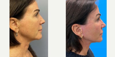 Neck Lift before and after photo