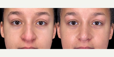 Rhinoplasty before and after photo