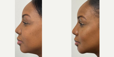 Buccal Fat Removal before and after photo
