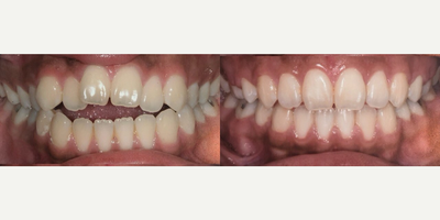 Clear Braces before and after photo